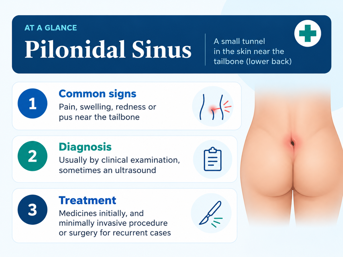 Pilonidal Sinus infographic